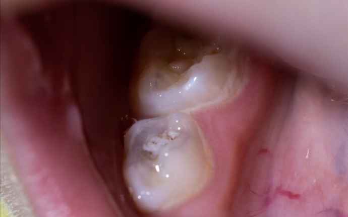 Karies är en bakteriesjukdom, hål i tänderna