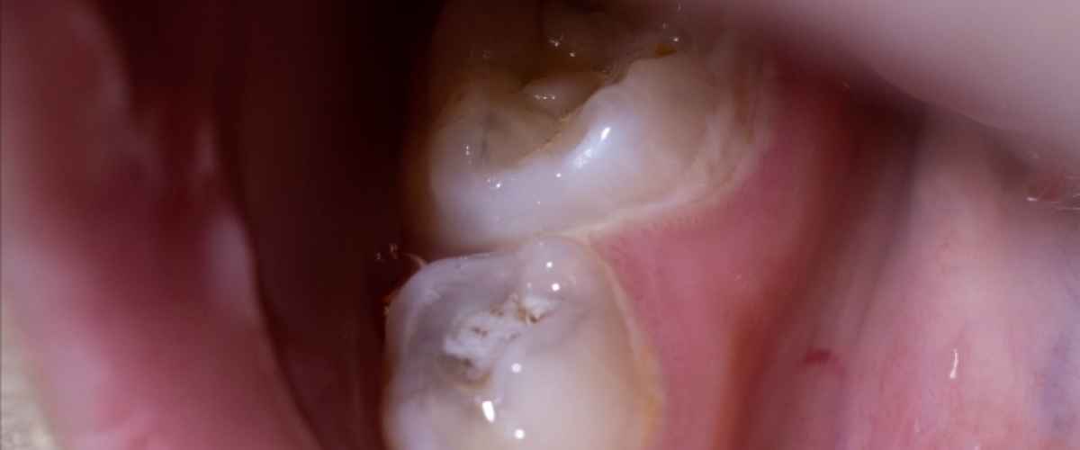 Karies är en bakteriesjukdom, hål i tänderna