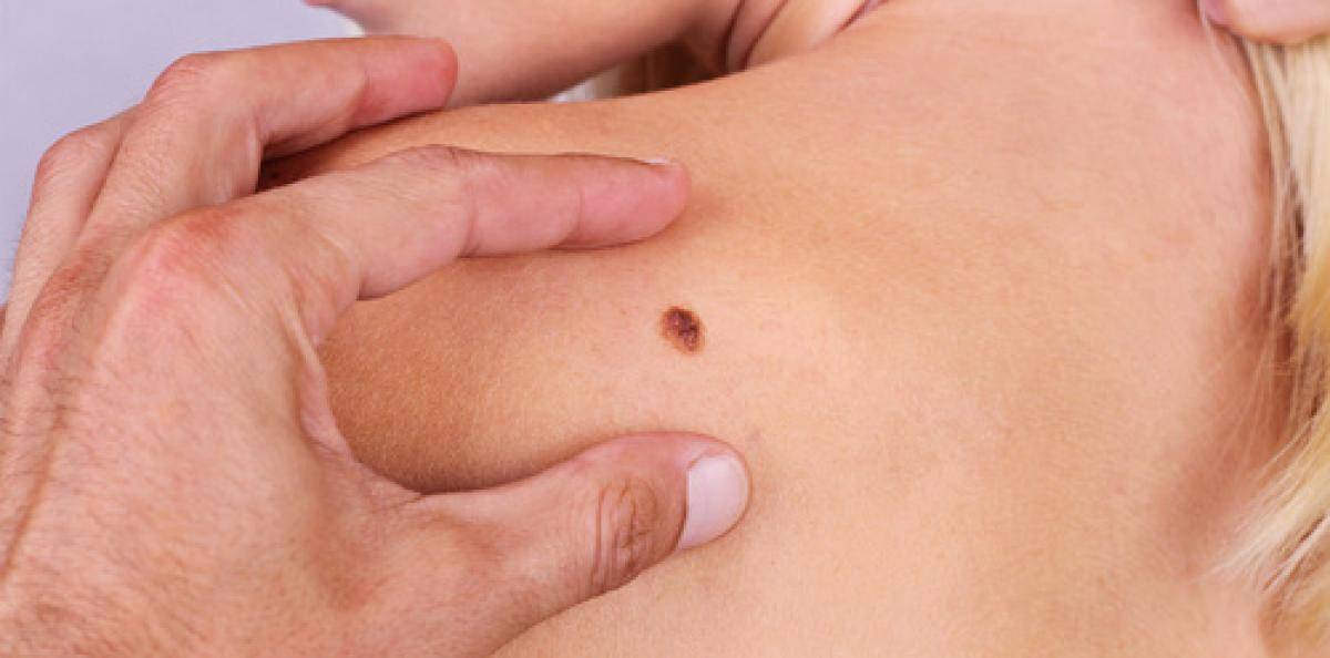 Skräcksiffror ger inte färre fall av malignt melanom 