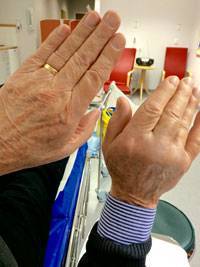 Sture Hedenskogs högerhand har svullnat upp efter enzyminjektionen. Helt normalt, enligt kirurg Stephan Wilbrand.