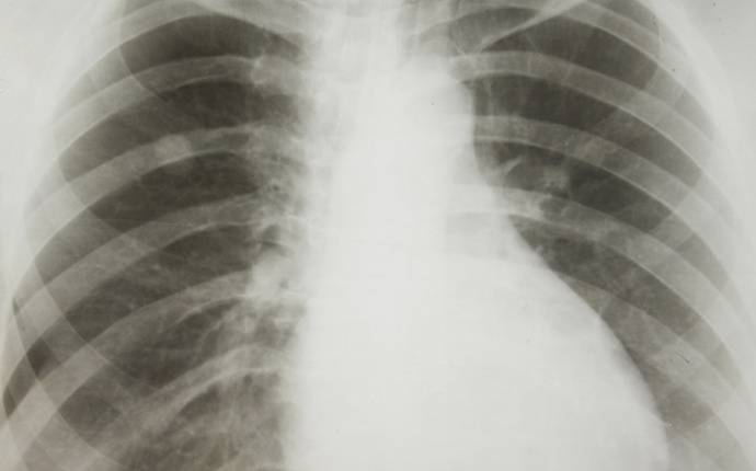 Symtom på lungcancer – tidig diagnos ökar överlevnaden