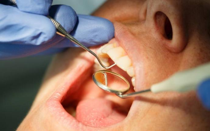 Tandvård och problem i munnen vid cancer - multipelt myelom. Sår i munnen, svamp och muntorrhet.