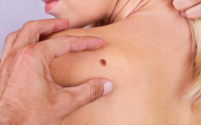 Skräcksiffror ger inte färre fall av malignt melanom 