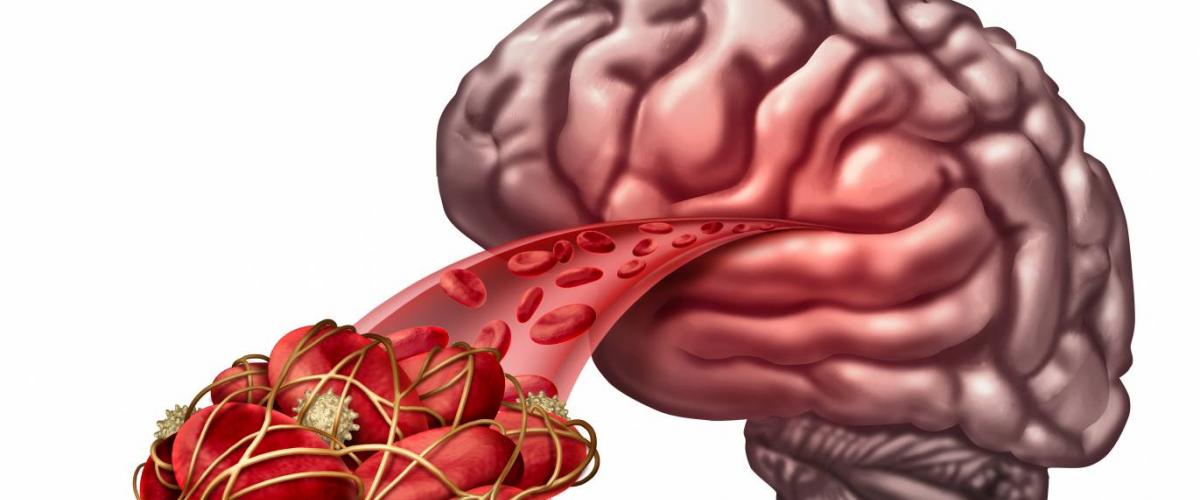 Blodpropp i hjärnan - stroke