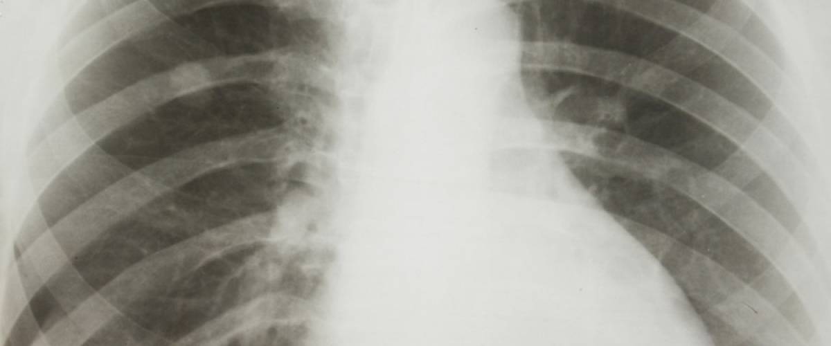 Symtom på lungcancer – tidig diagnos ökar överlevnaden