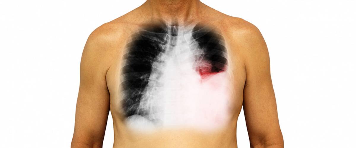 10 myter om lungcancer