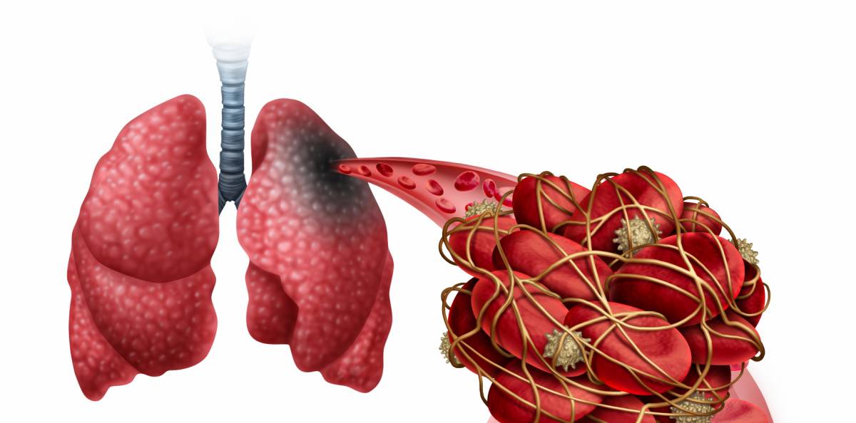 Blodpropp i lungan