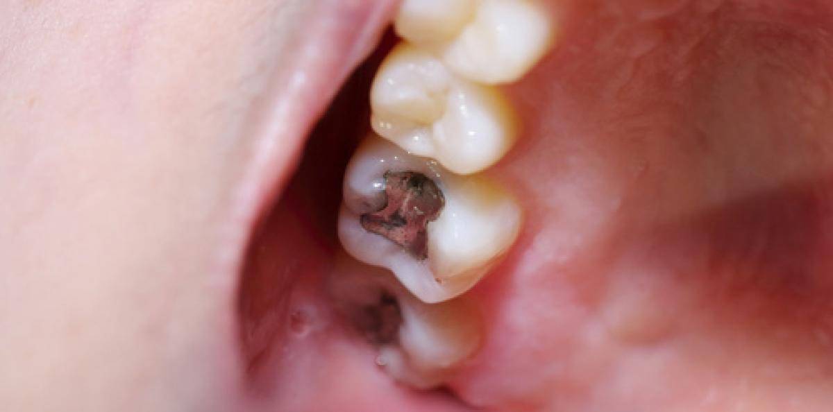 EU inför förbud mot amalgam i barns tänder 