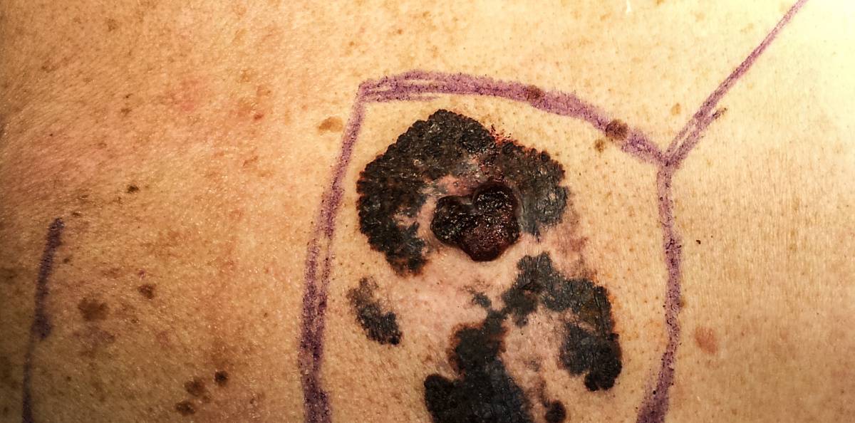 Studie: Läkemedelskombo kan förlänga livet vid spridd hudcancer