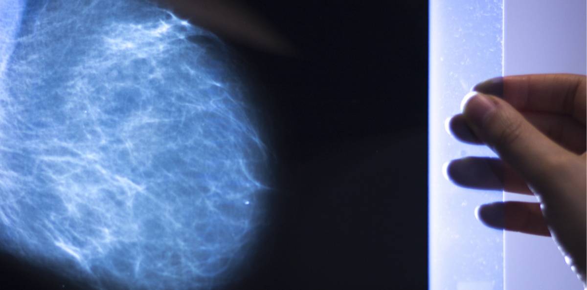 Olika typer av bröstcancer, symtom och mammografi