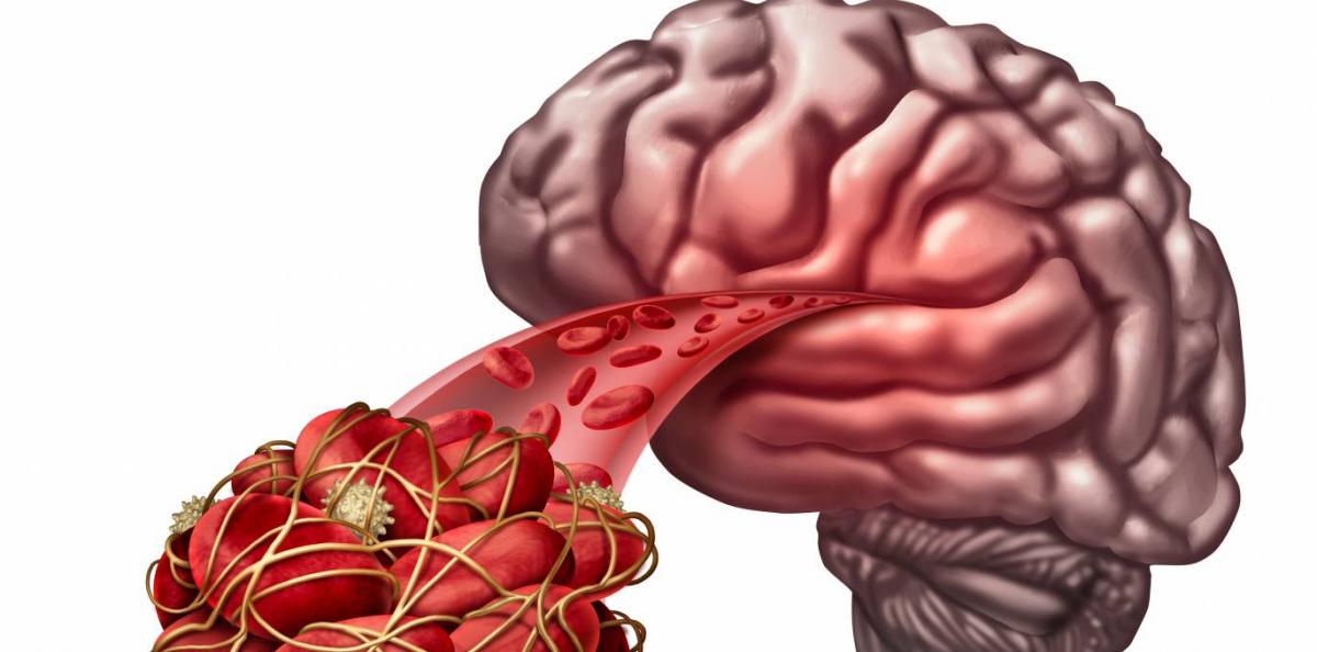 Blodpropp i hjärnan - stroke