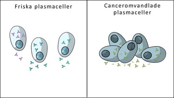 Friska plasmaceller vs plasmaceller som omvandlats till cancerceller, myelom