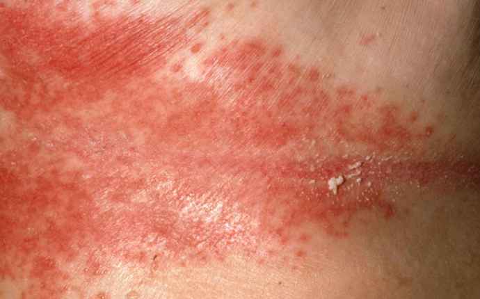 Jästsvampsinfektion i huden (candida)