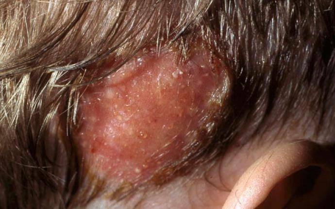 Svamp i hårbotten (Tinea capitis) kan ge kala fläckar eller fjällande hud