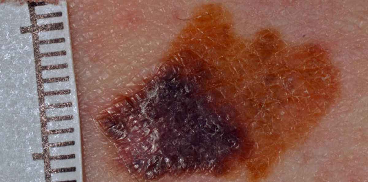 Hudcancer (malignt melanom)