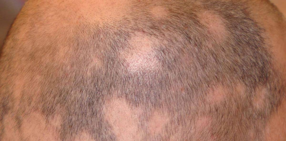 Alopeci (håravfall)