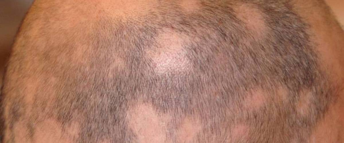 alopeci-haravfall-bild-alopecia-areata_1.jpg