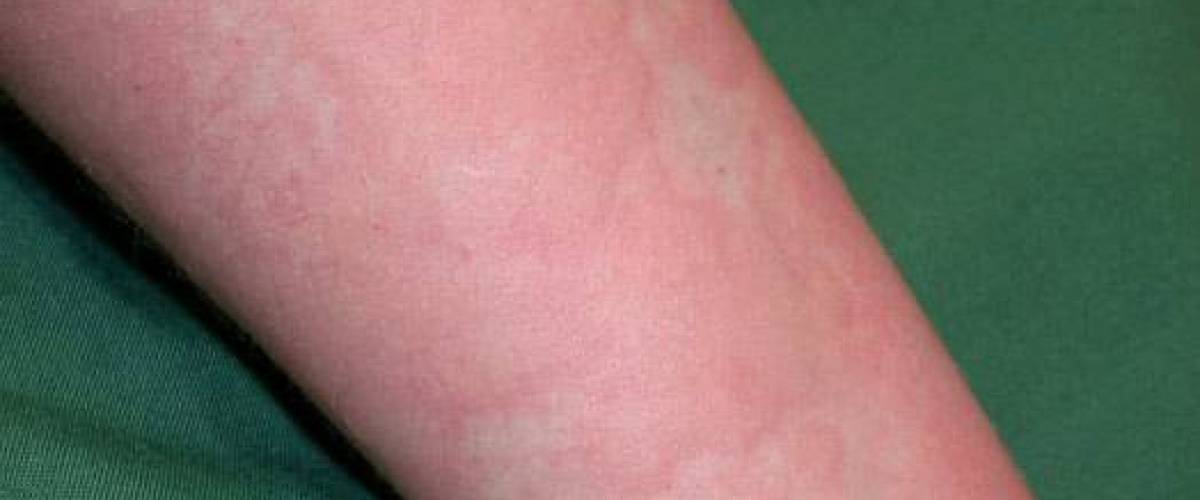 Urtikaria eller nässelutslag på arm