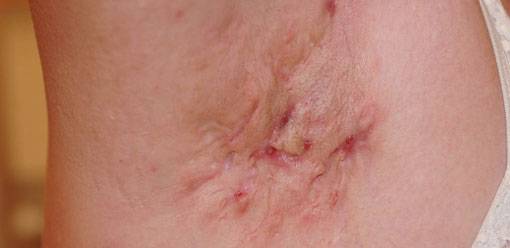 Bild på Hidradenitis suppurativa (HS, acne inversa, hidradenit)