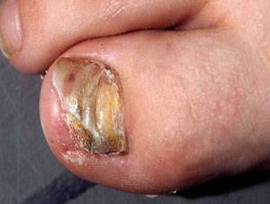 Nagelsvamp kan göra nageln missfärgad och porös.