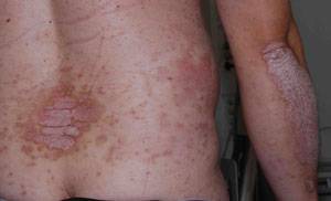 Psoriasis ger röda, fjällande utslag. Plackpsoriasis är den vanligaste formen. 